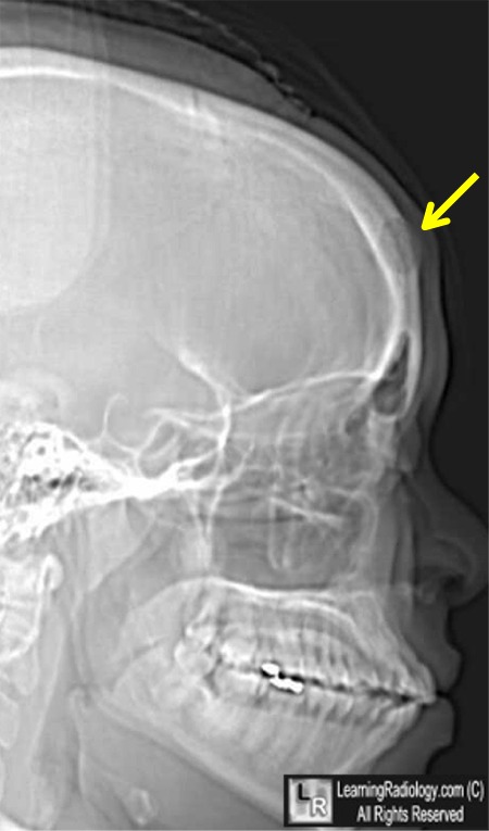 Dermoid Cyst of Skull
